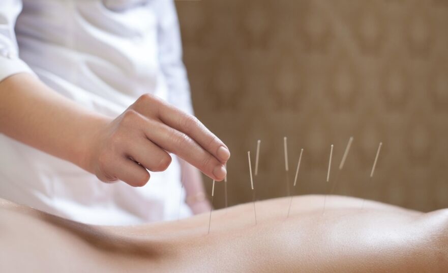 acupuncture